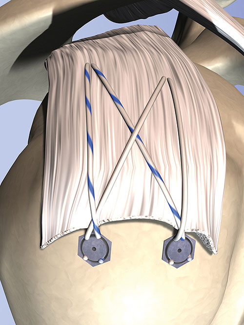 收缩 -  CNC-IMAGE-1.JPG