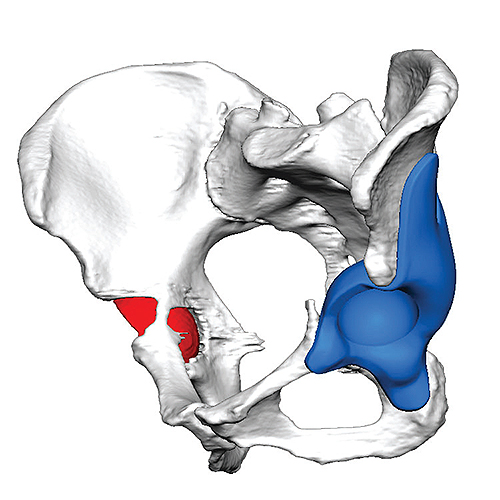 Medical Modeling为Enztec设计的翻修髋关节植入物。