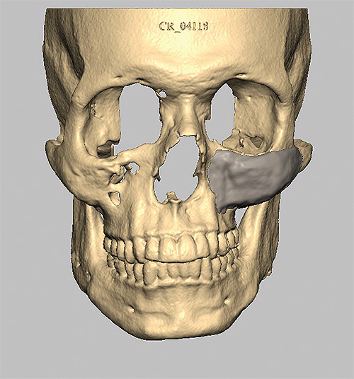 custom-cheekbone-implant
